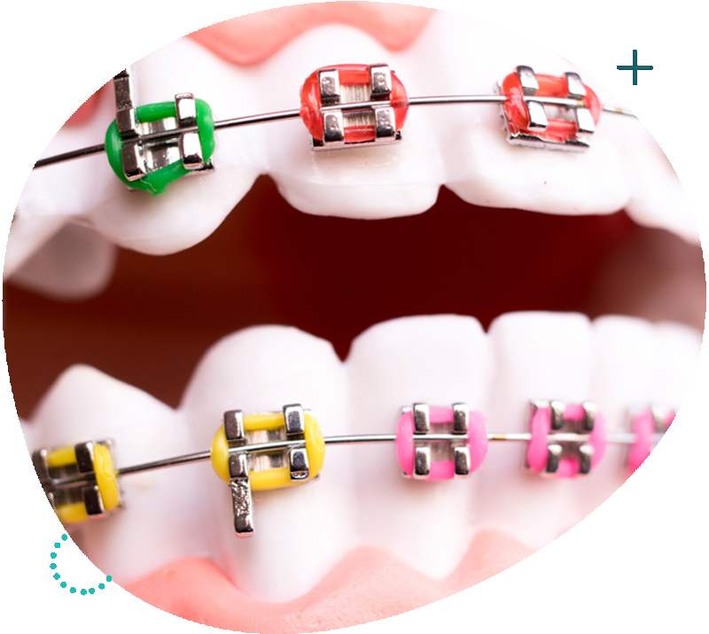 Stainless Steel Braces Singapore