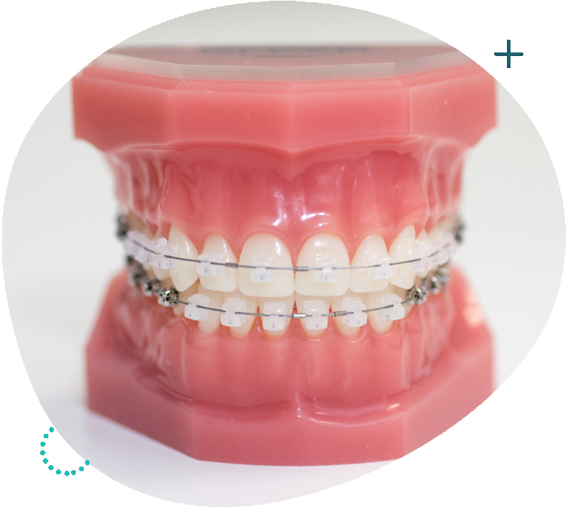 https://staging.thebracespractice.com/wp-content/uploads/2022/06/service5-1-1.jpg